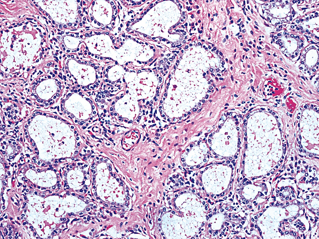 dyshormonogenetic-goiter-pathology